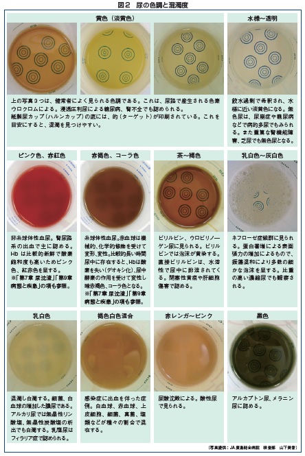 尿の色調と褐色度 画像